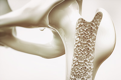 Osteoporosis – The Risks For Men & Women