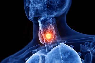Thyroid Cancer on the Rise